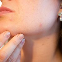 acne-1606765_1280